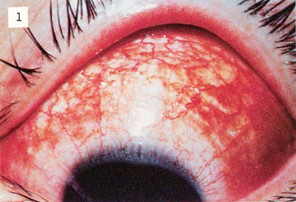 急性出血性結膜炎の眼病変の画像