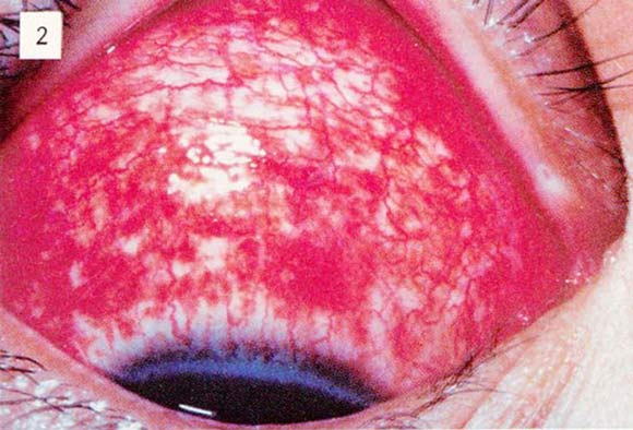 急性出血性結膜炎の眼病変の赤みが強い画像