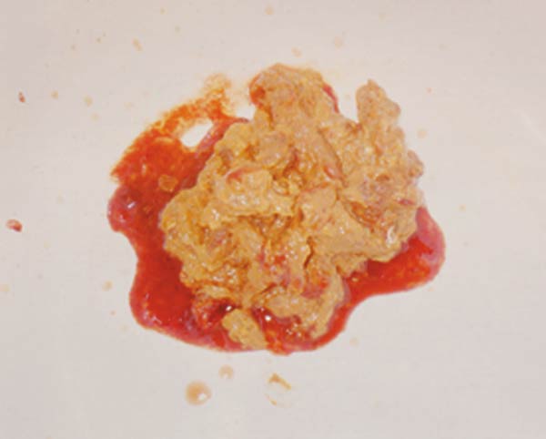 アメーバ赤痢の粘血便の画像