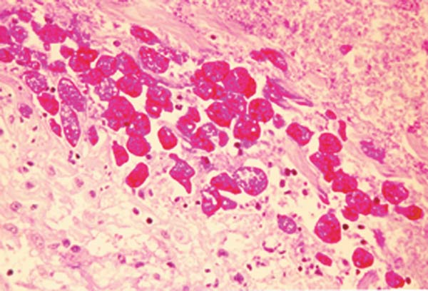 組織内に検出された赤痢アメーバ栄養体の集簇の画像