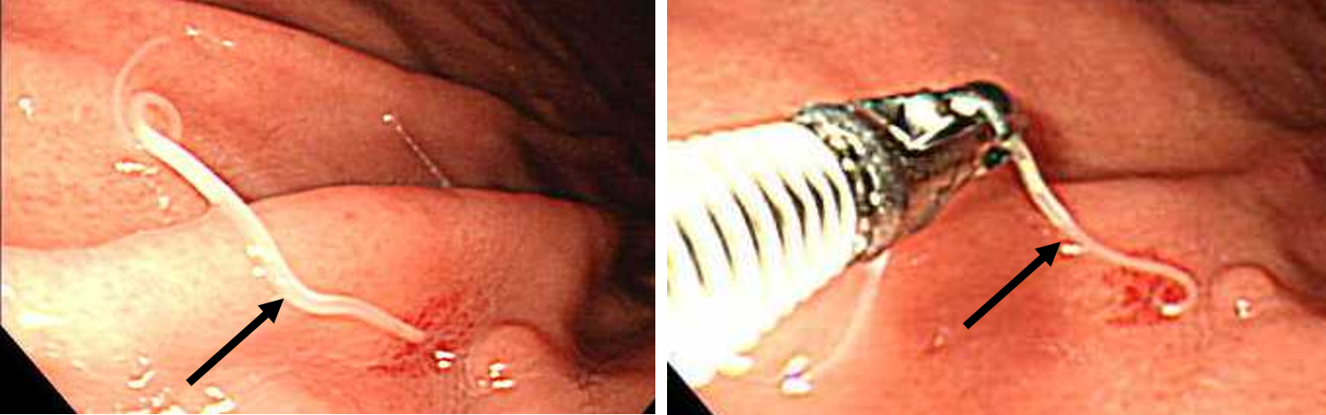 胃の内視鏡検査の画像