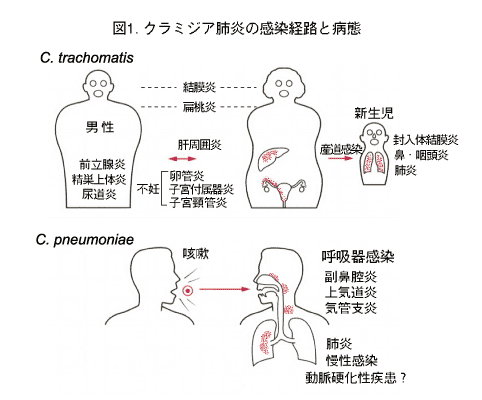 クラミジア肺炎の感染経路と病態の画像