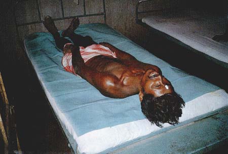 重症コレラ患者の痙攣の画像