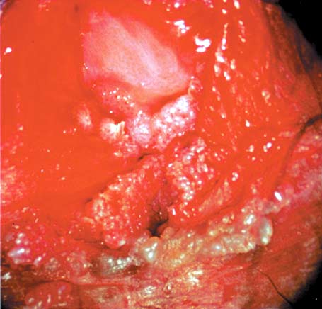 図2. 女性外陰部のコンジロームの画像