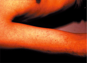 デング熱患者の発疹（日本人男性患者）の画像