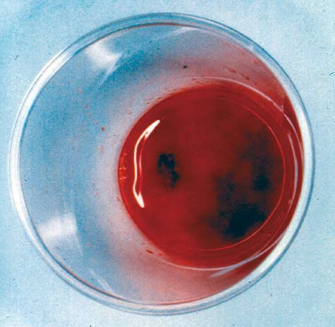 腸管出血性大腸菌O157:H7感染時の血便の画像