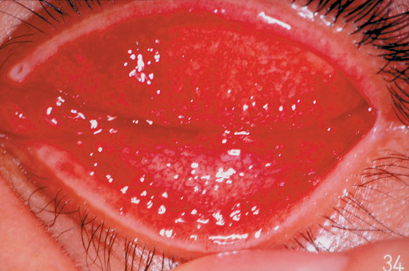 アデノウイルス感染による急性結膜炎の臨床写真。結膜は明るい赤色に充血し、特徴的な濾胞形成が見られる。