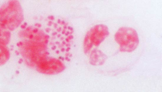 図2．男性尿道炎患者からの尿道分泌物の塗抹標本（グラム染色）の画像