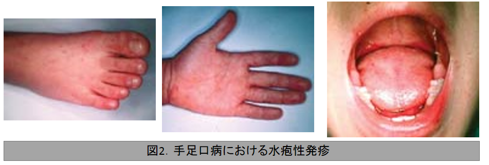 手足口病の特徴的な水疱性発疹を示す3枚の臨床写真。1枚目は足の発疹、2枚目は手のひらの発疹、3枚目は口腔内（咽頭部）の発疹を示している。いずれも鮮紅色の紅斑を伴う小水疱性の病変が観察される。手足口病の3主要部位における特徴的な皮疹の形態を示す写真。