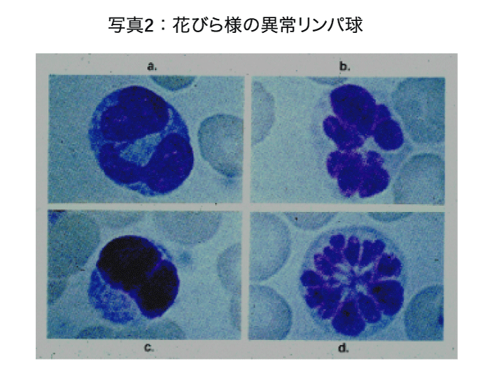 花びら様の異常リンパ球の画像