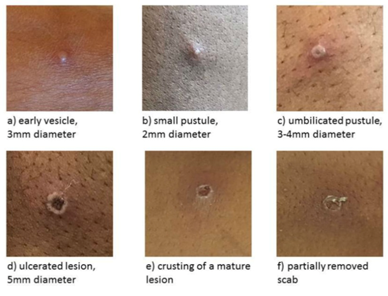 サル痘の皮疹の進行段階を示す6枚の臨床写真（a～f）。a） 早期の小水疱（直径3mm）、b） 小膿疱（直径2mm）、c） へそ様陥凹のある膿疱（直径3-4mm）、d） 潰瘍化した病変（直径5mm）、e） 成熟期の痂皮形成、f） 部分的に剥離した痂皮。各段階で特徴的な形態変化が観察できる。出典はUK HSA（2022年）。