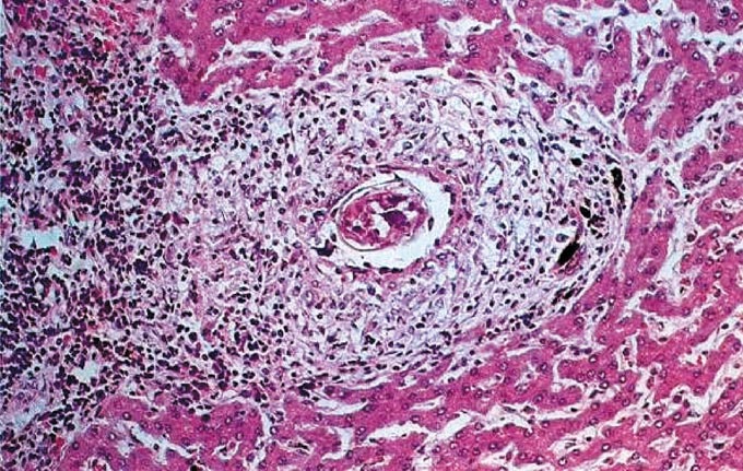 日本住血吸虫症における肝組織像の画像