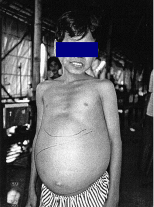 メコン住血吸虫症患者における肝脾腫と腹水貯留の画像