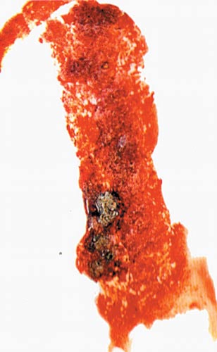 細菌性赤痢の典型的な膿粘血便の写真。鮮やかな赤色の血液成分と粘液、及び暗褐色の便成分が混在している。