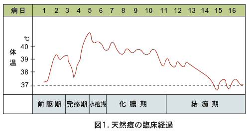 天然痘の臨床経過のグラフの画像