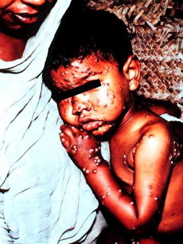 天然痘の典型的な発疹の画像