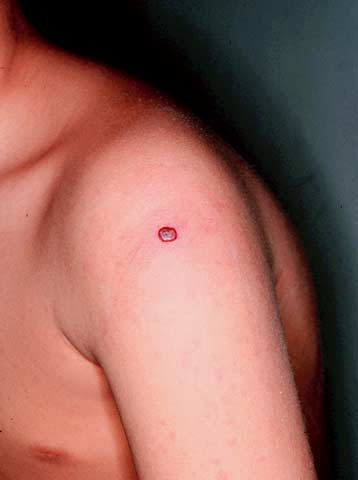 種痘部位の反応の画像