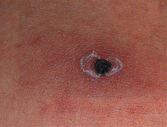 ダニの刺し口の画像