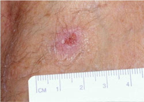 図1：びらんを有する丘疹（ブルーリ潰瘍、WHO）の画像