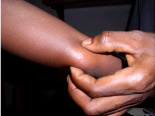 図2：腕の皮下結節（ブルーリ潰瘍、WHO）の画像