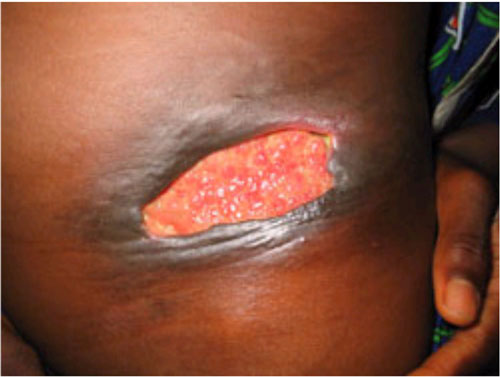 図3：潰瘍（ブルーリ潰瘍、WHO）の画像