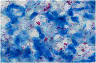 らい菌の顕微鏡写真