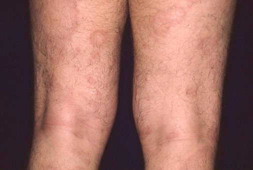 写真：多菌型（膝裏）の皮膚病変