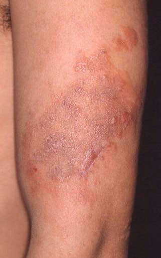 写真：多菌型（上腕）の皮膚病変