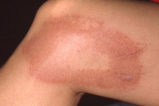 写真：少菌型（膝）の皮膚病変