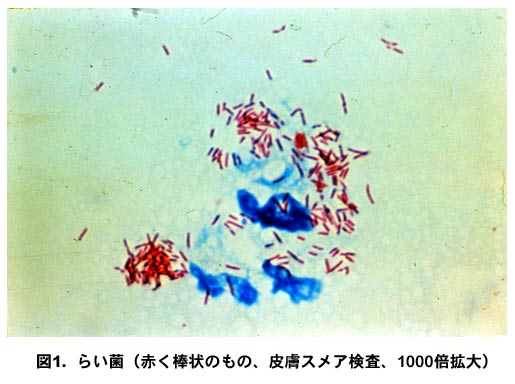 ハンセン病の皮膚スメア検査の顕微鏡写真（1000倍拡大）。青く染まった細胞の周囲に赤く染色されたらい菌（桿状菌）が多数観察される。