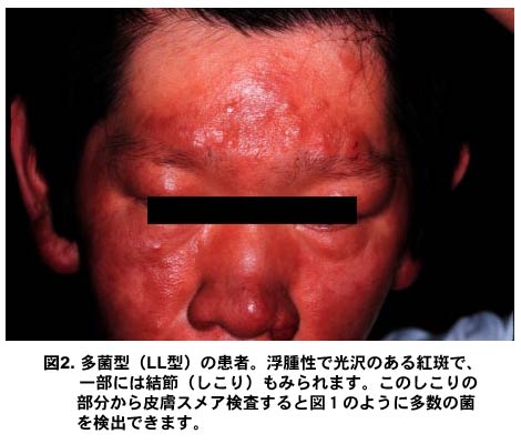 ハンセン病の多菌型（LL型）の臨床写真。顔面に浮腫性の光沢のある紅斑が広がり、一部に結節（しこり）が認められる。この病変部位から採取した皮膚スメア検査で、多数の菌を検出できることを示す診断的意義のある写真。患者のプライバシーを保護するため、目の部分は黒い帯で隠されている。
