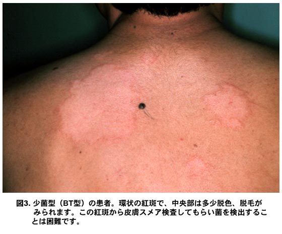 ハンセン病の少菌型（BT型）の臨床写真。患者の背部に環状の紅斑が認められ、病変の中央部は脱色素化し、脱毛も観察される。この型の特徴として、皮膚スメア検査では菌の検出が困難であることを示す診断的意義のある写真。紅斑は境界明瞭で、典型的なBT型の臨床像を示している。