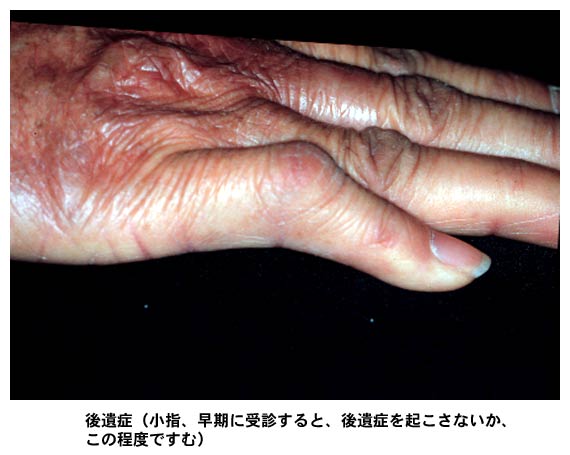 ハンセン病の後遺症を示す手の臨床写真。早期の受診で予防可能な症状だが、進行すると手指の変形や皮膚の萎縮が生じる。この症例では手の甲から指にかけて皮膚の萎縮性変化と関節の変形が見られ、特に手の甲の部分に顕著な瘢痕化と皺の形成が観察される。早期診断・治療の重要性を示す教育的な写真。