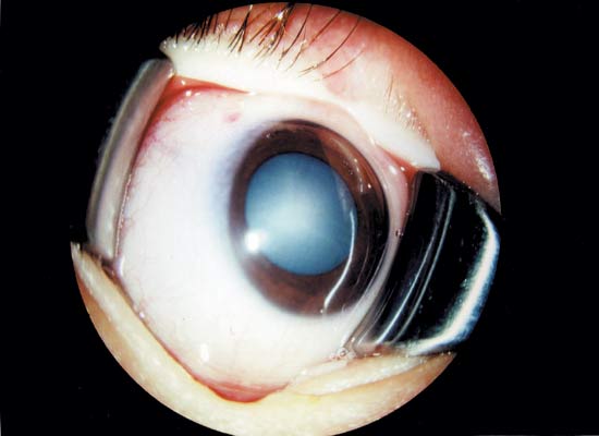図3：CRS白内障（杏林大学医学部藤原隆明博士提供）の画像